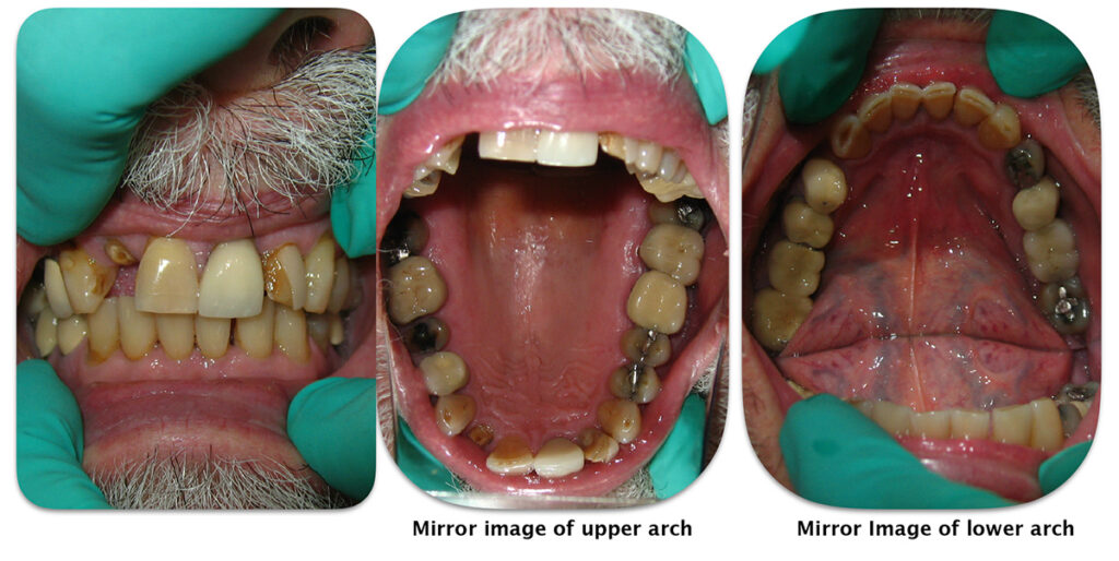 Initial photo of generalized dentaldeteriorarion