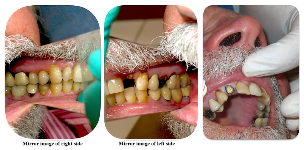 Patient wants upper left lateral incisor restored.