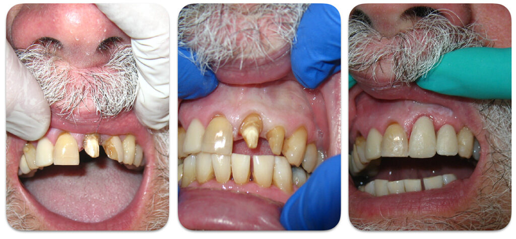 Initial preparations of the upper left central incisor